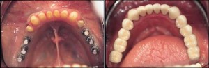 Implante Dental Caso 2